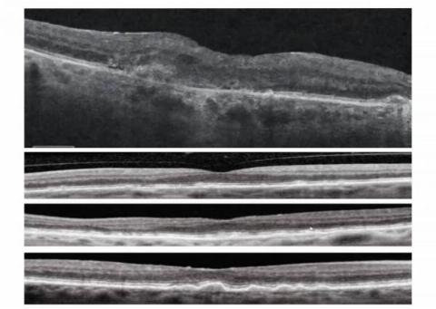 Age-Related Macular Degeneration by Dr. Rasha Tariq Al-Aswad